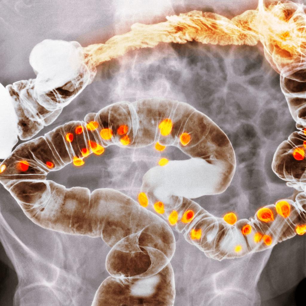 Best Probiotics for Diverticulitis